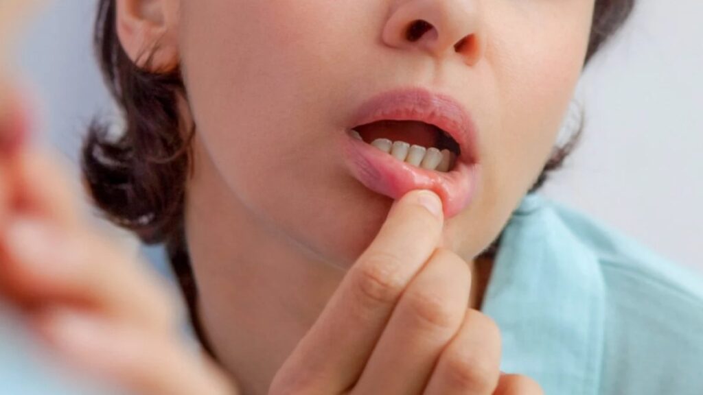 agiz icerisinde cikan ve gecmeyen yaralar kansere davetiye cikariyor SW8VqDHp