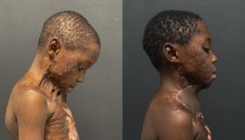 kamerunda boynu yanip cenesi govdesine yapisan cocuk turkiyede sifa buldu Ke4ulk89