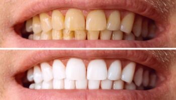 dis tasi temizliginde bilinmesi gerekenler enfeksiyona neden olur mu BXrQGQtL