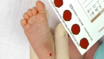 topuk kani zorunlu mu alinmazsa ne olur topuk kaninda cikan hastaliklar nIr4bfYb