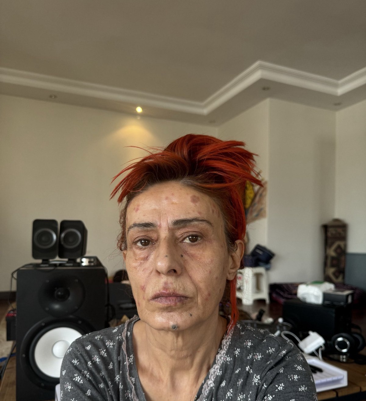 Yıldız Tilbe, saç boyasından sonra yüzünün yandığını duyurdu 1 yildiz tilbe sac boyasindan sonra yuzunun yandigini duyurdu 0 4IzETaLW