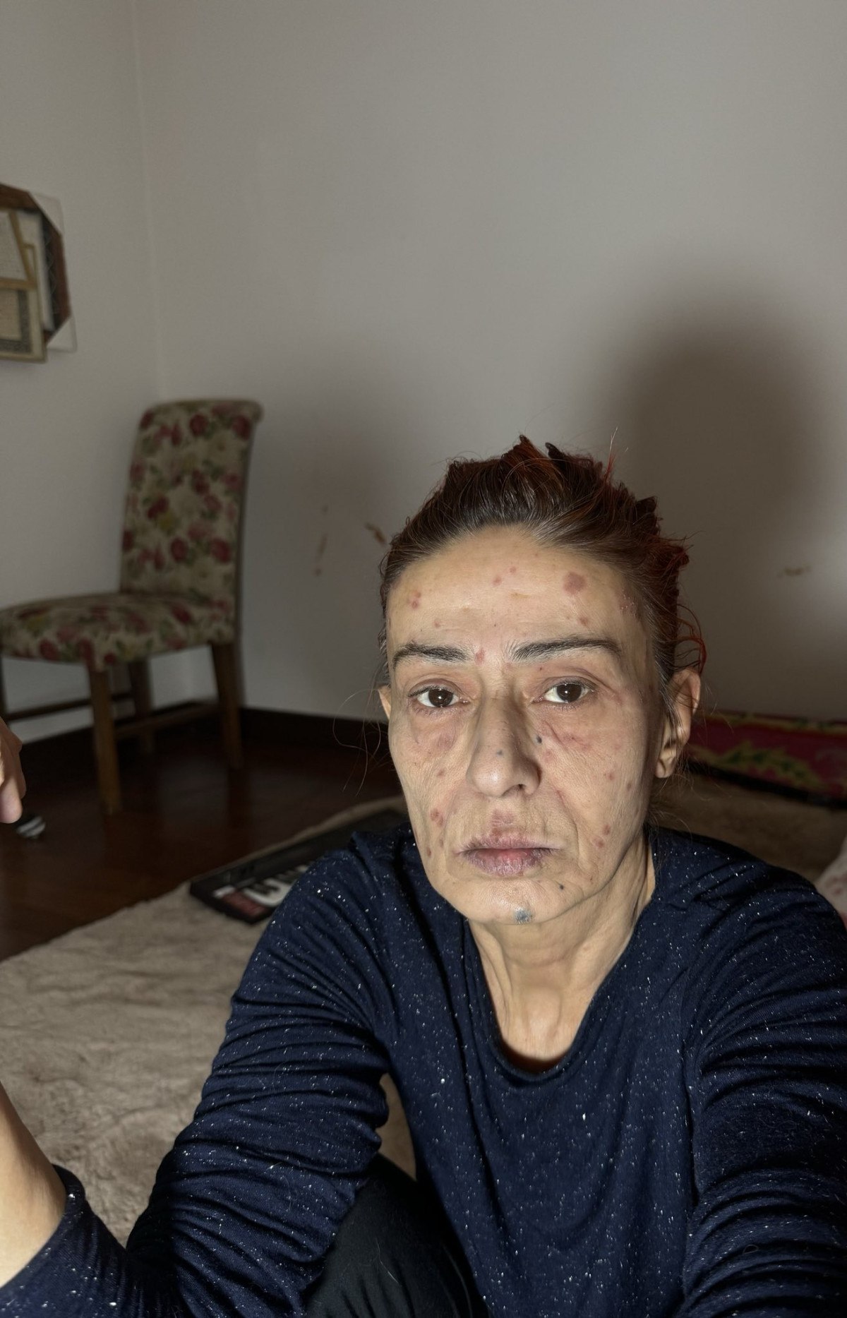 Yıldız Tilbe, saç boyasından sonra yüzünün yandığını duyurdu 2 yildiz tilbe sac boyasindan sonra yuzunun yandigini duyurdu 1