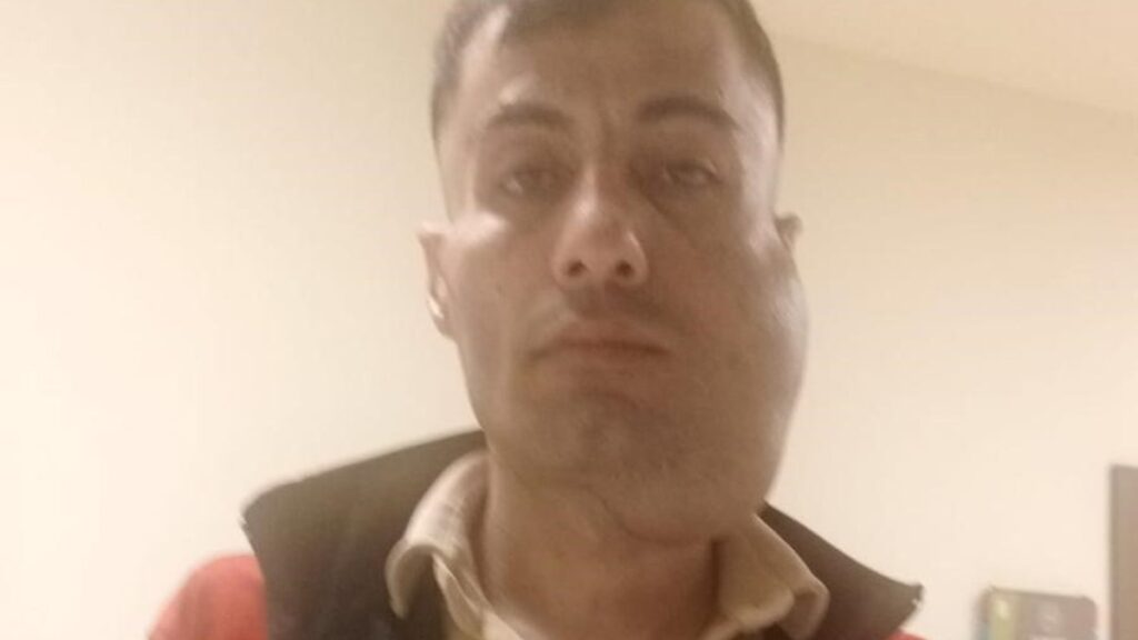 18 santimetrelik tumorunden kurtuldu artik yeni bir yuzu var hnva1lz8