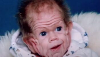 bilim dunyasini hayrete dusurmustu yasli bir insanin cildiyle dogan bebegin yillar sonraki degisimi kAsjbc1t