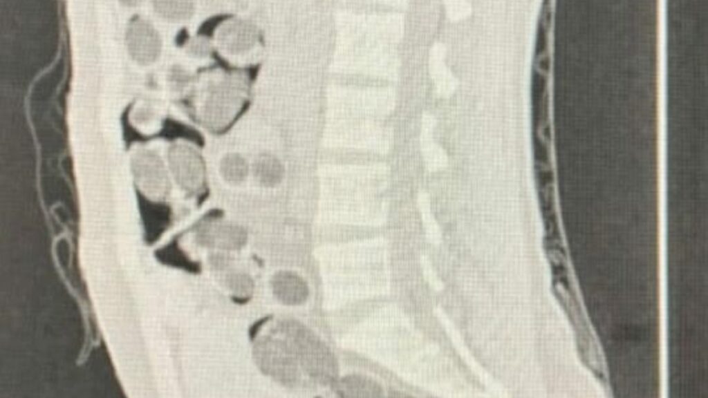 denizlide yabanci uyruklu yolcunun midesinden 219 paket uyusturucu cikti VFc5m6Gi
