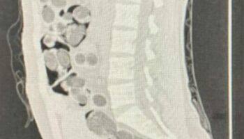 denizlide yabanci uyruklu yolcunun midesinden 219 paket uyusturucu cikti VFc5m6Gi