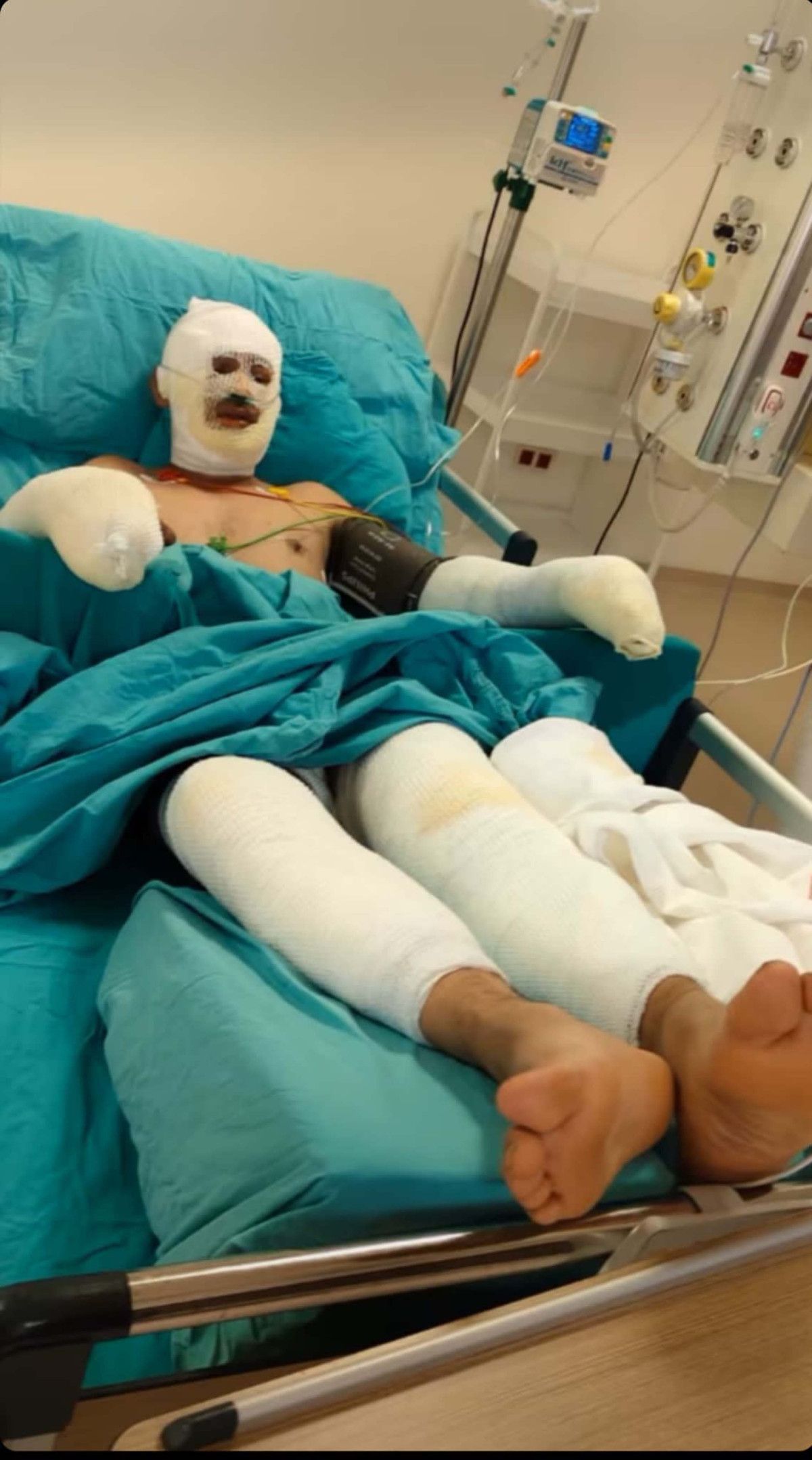 eskisehirdeki orman yanginina mudahale ederken agir yaralanan esini paylasti 1 6puygvNd