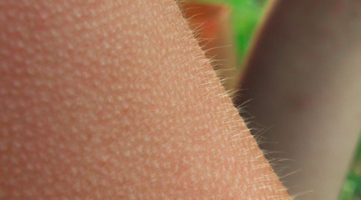 tuylerin diken diken olmasinin nedeni bakin neymis 0 OC71lTYA