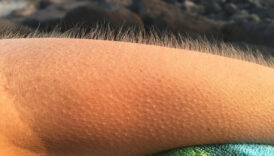 Tüylerin diken diken olmasının nedeni bakın neymiş… 5 tuylerin diken diken olmasinin nedeni bakin neymis aPxVvRVC