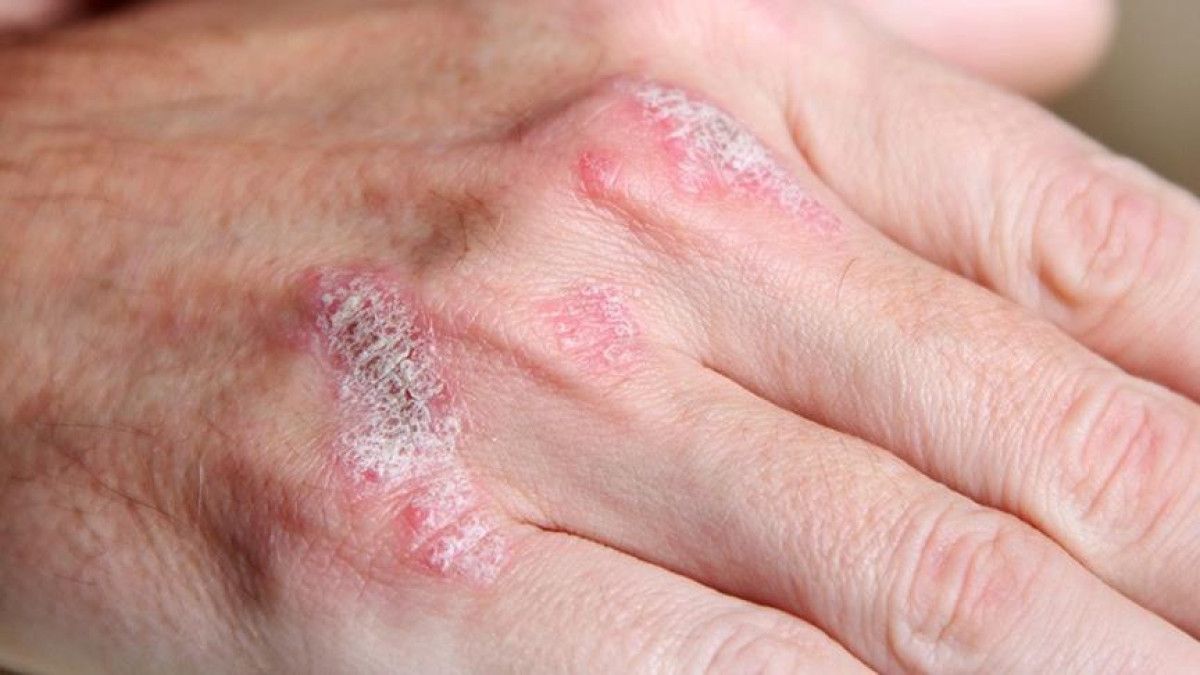 sedef romatizmasinin hasari tedaviyle onleniyor 1 5UsZjwOr