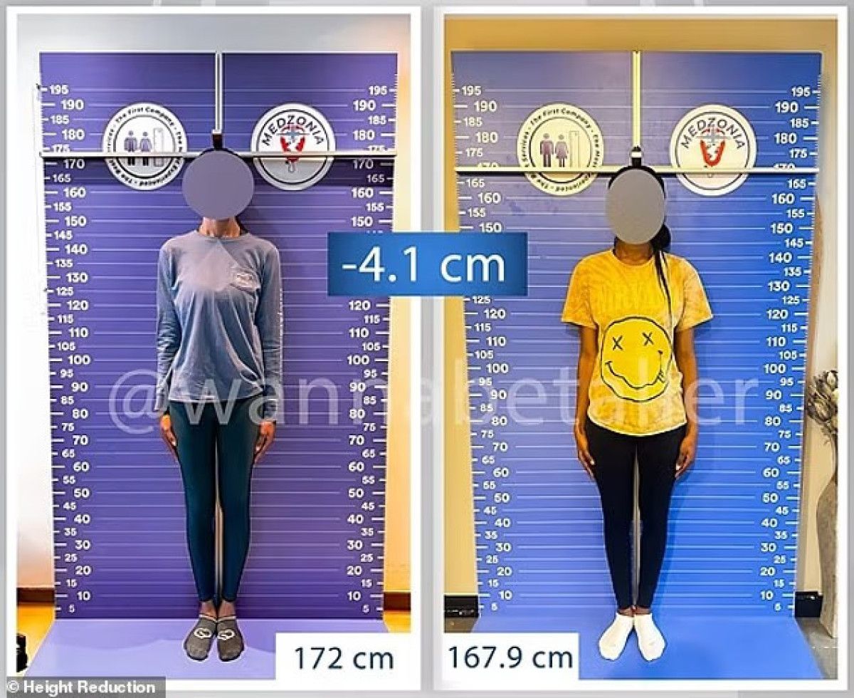 Yabancılardan bir garip trend: Boy kısaltma için Türkiye'ye geliyorlar 1 yabancilardan bir garip trend boy kisaltma icin turkiyeye geliyorlar 0 qqTtZ2RF