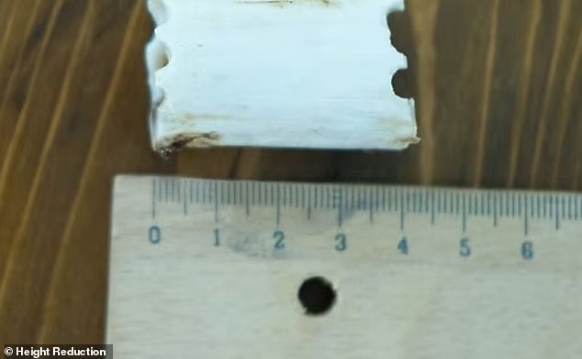 Yabancılardan bir garip trend: Boy kısaltma için Türkiye'ye geliyorlar 2 yabancilardan bir garip trend boy kisaltma icin turkiyeye geliyorlar 1 pFSISs1U