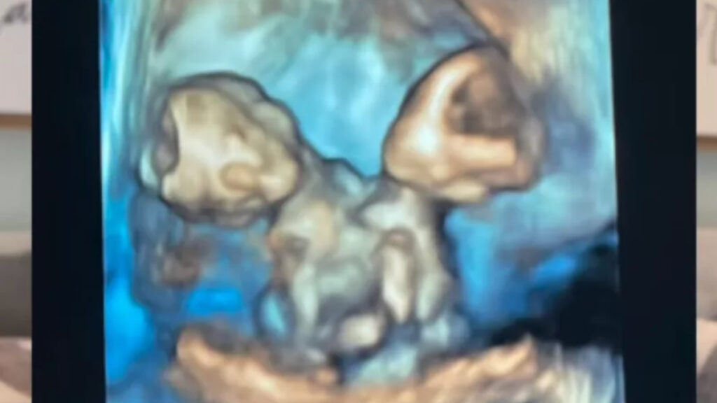 abdde bir anne zor olani secti yapisik ikizler dogar dogmaz hayata veda ettiler DlfjhCMz