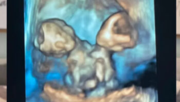 abdde bir anne zor olani secti yapisik ikizler dogar dogmaz hayata veda ettiler DlfjhCMz