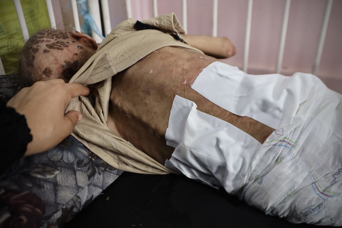 gazzede aci tablo 7 yasindaki mey saglik sorunlariyla mucadele ediyor 0 ckgZ6mYl