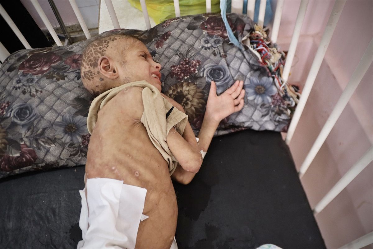 gazzede aci tablo 7 yasindaki mey saglik sorunlariyla mucadele ediyor 1