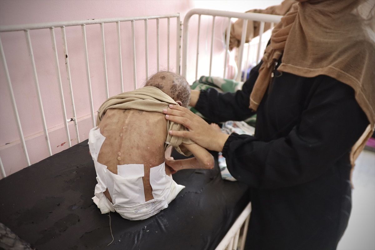 gazzede aci tablo 7 yasindaki mey saglik sorunlariyla mucadele ediyor 2 WPttkfCN