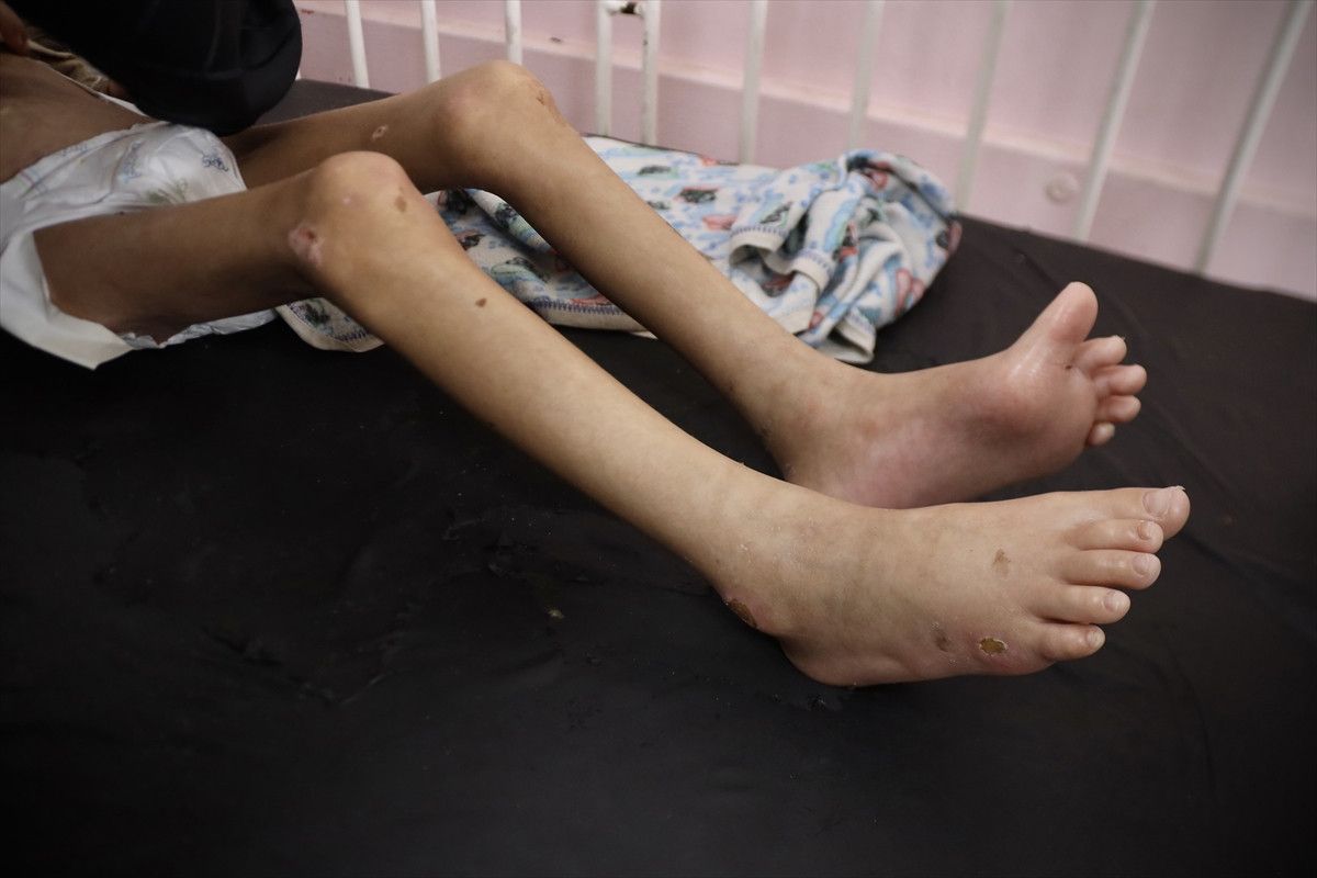 gazzede aci tablo 7 yasindaki mey saglik sorunlariyla mucadele ediyor 4 G5lNaQFR