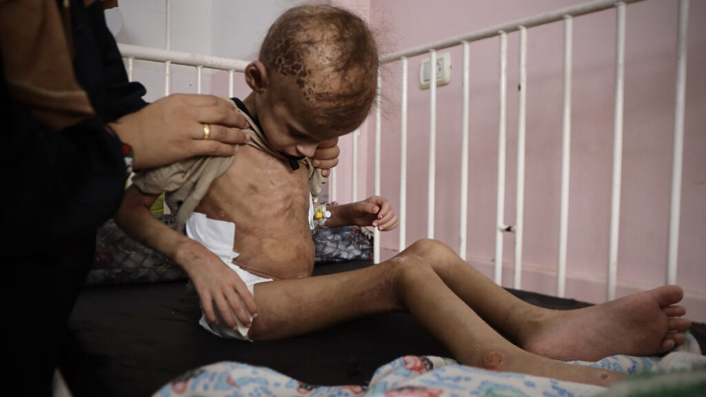 gazzede aci tablo 7 yasindaki mey saglik sorunlariyla mucadele ediyor p7CI4NcJ