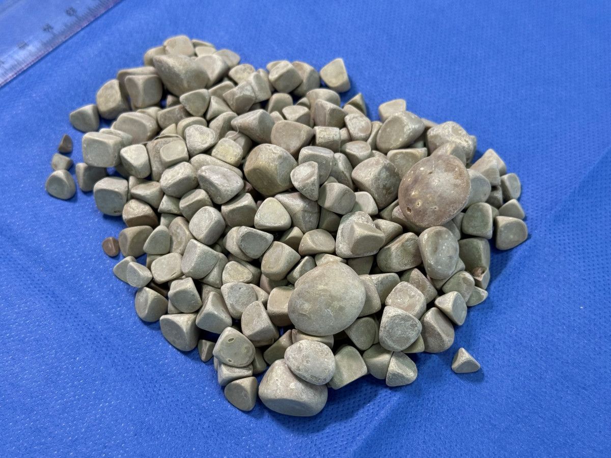 istanbulda karin agrisiyla doktora gitti vucudunda 287 tane tas cikti 1 z2VzRuSU