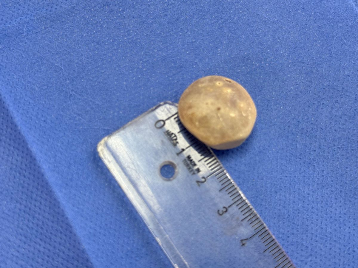 istanbulda karin agrisiyla doktora gitti vucudunda 287 tane tas cikti 5 UCfDDlhy